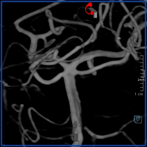 Basilar artery perforator aneurysm (Radiopaedia 82455-99524 3D Left VA 4).jpg