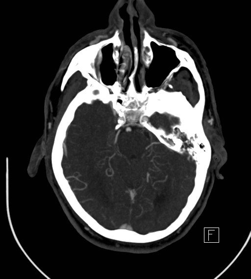 Basilar artery thrombosis (Radiopaedia 26986-27163 A 33).jpg