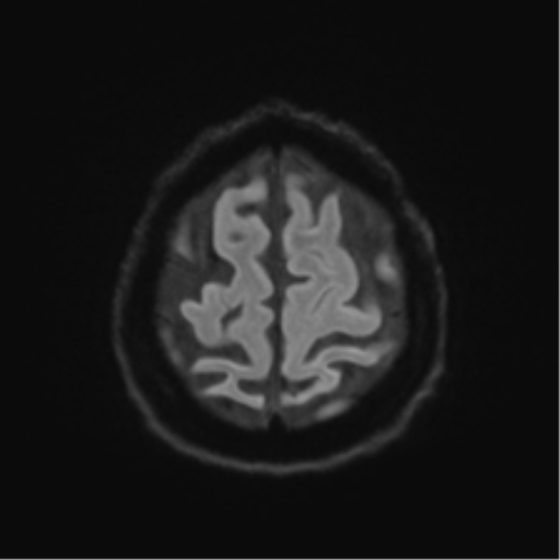 Behavioral variant frontotemporal dementia and late onset schizophrenia (Radiopaedia 52197-58083 Axial DTI Trace W 50).png