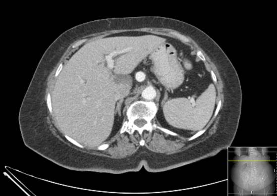 Bicameral celiacomesenteric aneurysm (Radiopaedia 55766-62327 A 13).jpg