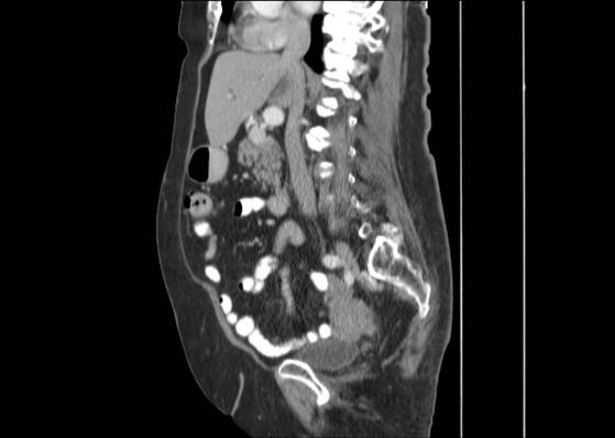 Bicameral celiacomesenteric aneurysm (Radiopaedia 55766-62327 B 26).jpg