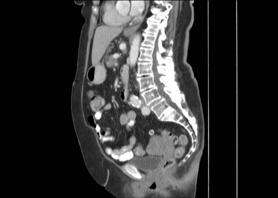 Bicameral celiacomesenteric aneurysm (Radiopaedia 55766-62327 B 31).jpg