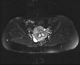 File:Bicornuate bicollis uterus (Radiopaedia 61626-69616 Axial PD fat sat 17).jpg