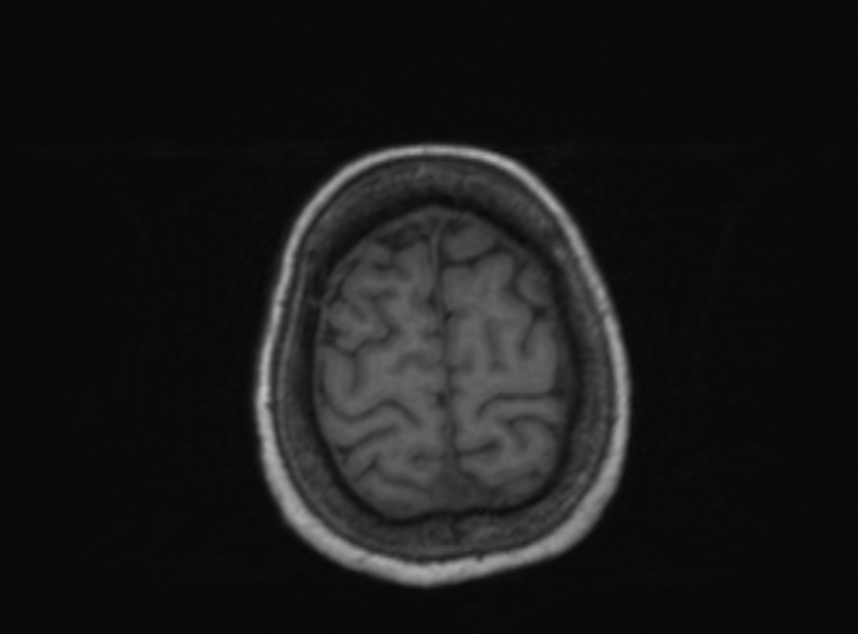 Bilateral PCA territory infarction - different ages (Radiopaedia 46200-51784 Axial T1 141).jpg
