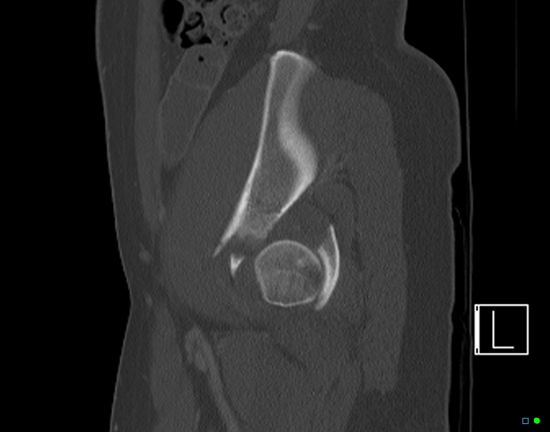 File:Bilateral acetabular fractures (Radiopaedia 79272-92308 Sagittal bone window 68).jpg