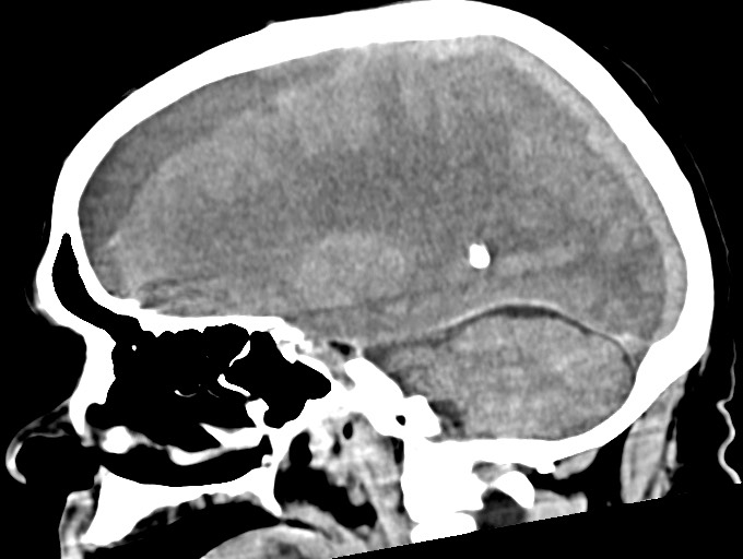 Bilateral acute on chronic subdural hematomas (Radiopaedia 78466-91146 C 35).jpg