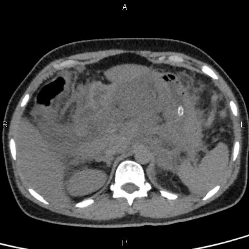 Bilateral adrenal gland hyperenhancement in pancreatitis (Radiopaedia 86642-102753 Axial non-contrast 30).jpg