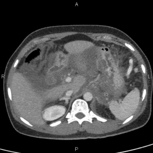 Bilateral adrenal gland hyperenhancement in pancreatitis (Radiopaedia 86642-102753 E 26).jpg
