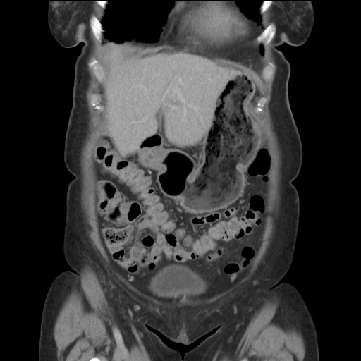 Bilateral adrenal granulocytic sarcomas (chloromas) (Radiopaedia 78375-91007 B 26).jpg