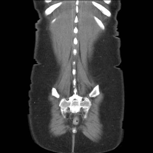 Bilateral adrenal granulocytic sarcomas (chloromas) (Radiopaedia 78375-91007 B 83).jpg