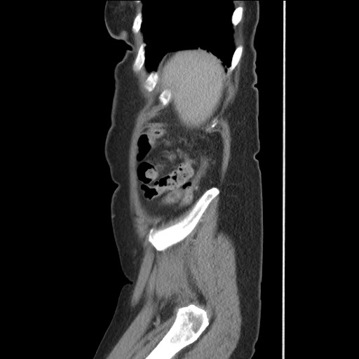 Bilateral adrenal granulocytic sarcomas (chloromas) (Radiopaedia 78375-91007 C 118).jpg