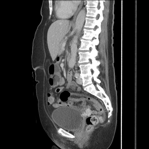 Bilateral adrenal granulocytic sarcomas (chloromas) (Radiopaedia 78375-91007 C 77).jpg