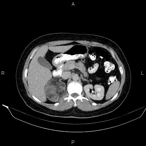 Bilateral adrenal myelolipoma (Radiopaedia 63058-71535 Axial C+ delayed 32).jpg