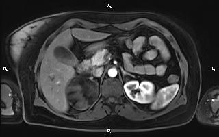 Bilateral adrenal myelolipoma (Radiopaedia 63058-71537 Axial T1 C+ fat sat 37).jpg