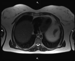 File:Bilateral adrenal myelolipoma (Radiopaedia 63058-71537 Axial T2 4).jpg