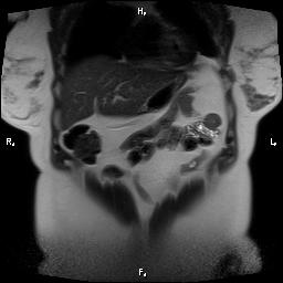 File:Bilateral adrenal myelolipoma (Radiopaedia 63058-71537 Coronal T2 27).jpg