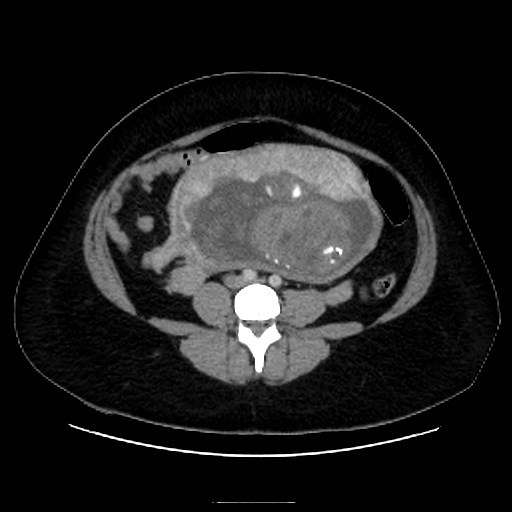 Bilateral adrenal thrombosis (Radiopaedia 58182-65256 A 46).jpg