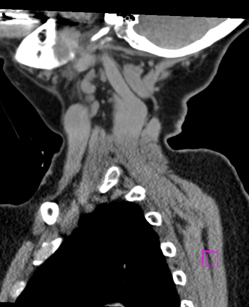 Bilateral atlanto-occipital assimilation (Radiopaedia 28350-28603 D 14).jpg