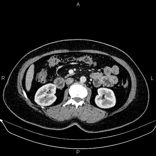 Bilateral benign adrenal adenomas (Radiopaedia 86912-103124 B 51).jpg