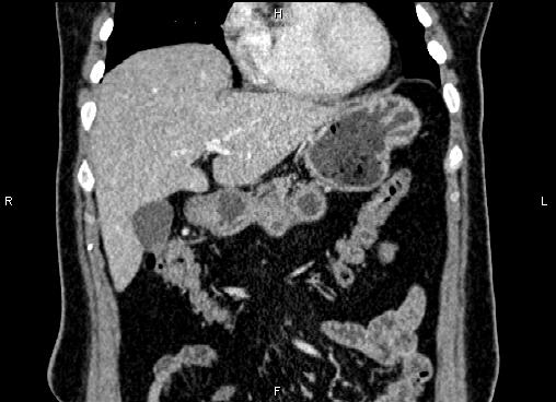 Bilateral benign adrenal adenomas (Radiopaedia 86912-103124 D 15).jpg