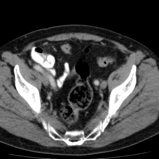 File:Bilateral direct inguinal herniae (Radiopaedia 17016-16719 B 8).jpg