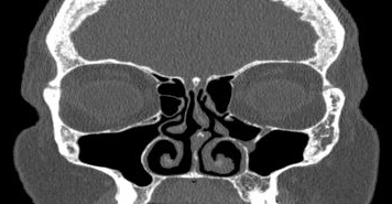 File:Bilateral ectopic infraorbital nerves (Radiopaedia 49006-54084 Coronal 43).png