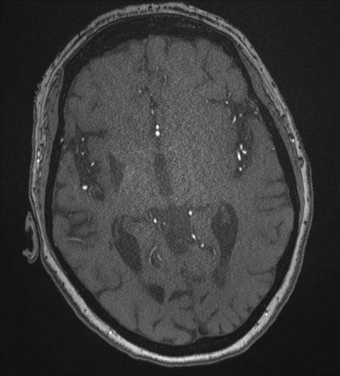 Bilateral fetal posterior communicating arteries (Radiopaedia 41286-44102 Axial MRA 105).png