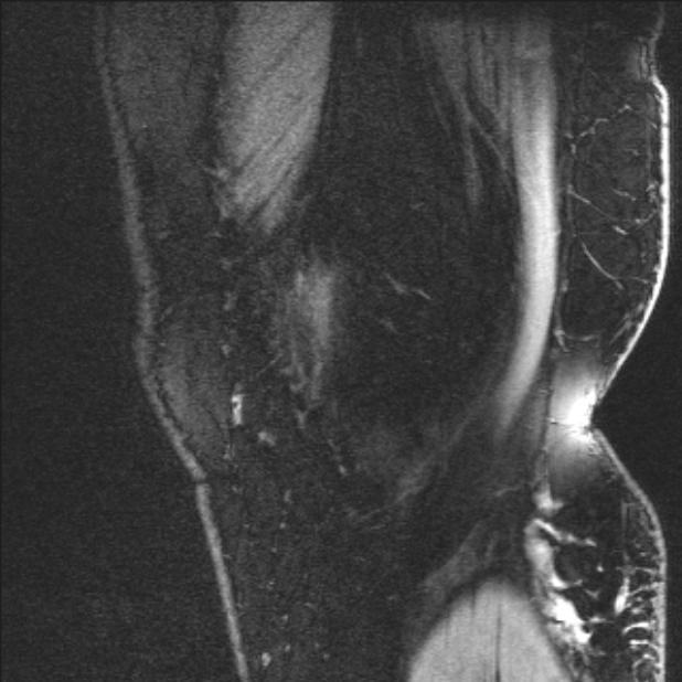 Bilateral focal pigmented villonodular synovitis (Radiopaedia 67643-77046 G 6).jpg