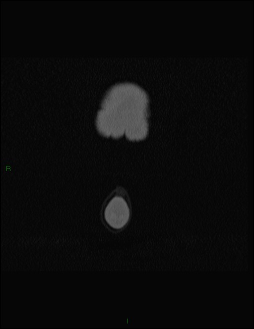 Bilateral frontal mucoceles (Radiopaedia 82352-96454 Coronal 6).jpg