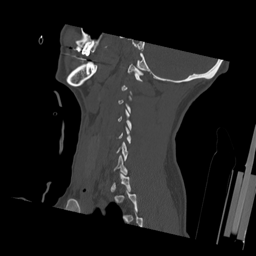Bilateral locked facets (Radiopaedia 33850-35023 Sagittal bone window 15).png