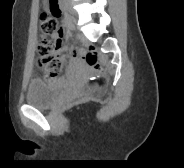 Bilateral mature cystic ovarian teratoma (Radiopaedia 88821-105592 D 22).jpg