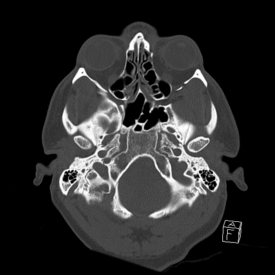 Bilateral occipital condyle fracture (type 2) (Radiopaedia 87675-104089 Axial bone window 19).jpg