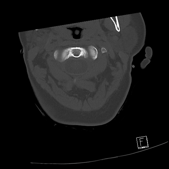 Bilateral occipital condyle fractures (type 3) (Radiopaedia 87672-104086 Axial bone window 20).jpg