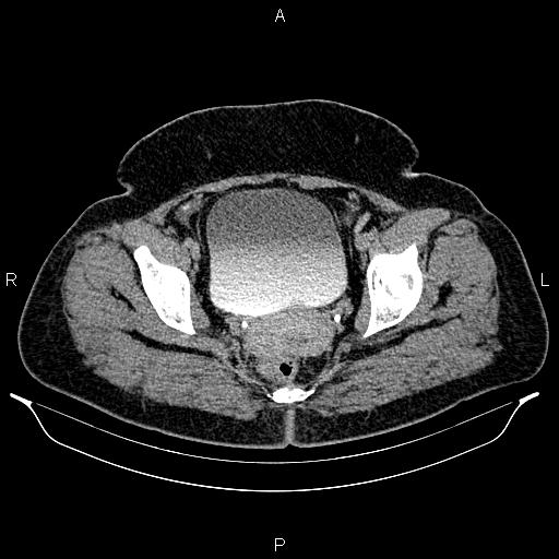 Bilateral ovarian dermoid cysts (Radiopaedia 85785-101603 Axial C+ delayed 77).jpg