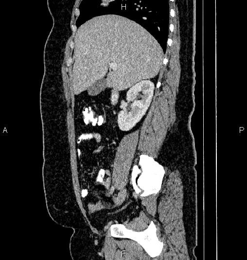Bilateral ovarian dermoid cysts (Radiopaedia 85785-101603 D 27).jpg