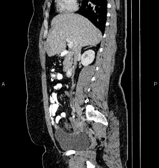 Bilateral ovarian dermoid cysts (Radiopaedia 85785-101603 D 34).jpg