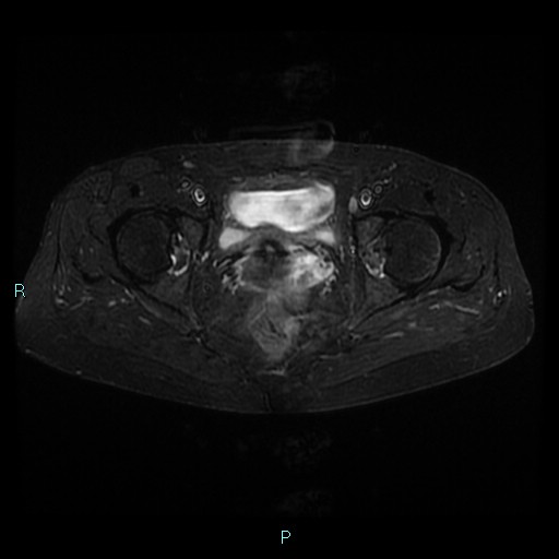 File:Bilateral ovarian fibroma (Radiopaedia 44568-48293 Axial STIR 20).jpg