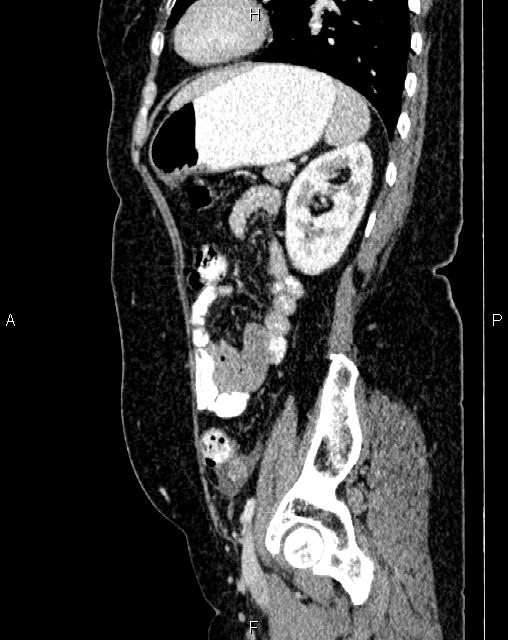 Bilateral ovarian serous cystadenocarcinoma (Radiopaedia 86062-101989 E 64).jpg