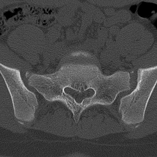 Bilateral pars defect (Radiopaedia 26691-26846 Axial bone window 78).jpg