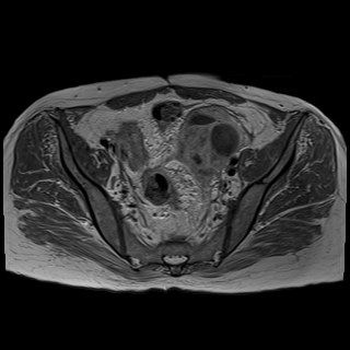 Bilateral tubo-ovarian abscesses (Radiopaedia 58635-65829 Axial T1 C+ 20).jpg