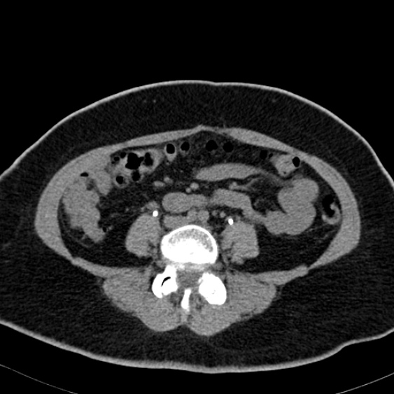 File:Bilateral ureteric stents (Radiopaedia 48795-53825 Axial non-contrast 36).jpg