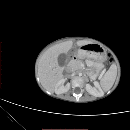 Biliary tract embryonal rhabdomyosarcoma (Radiopaedia 51815-57648 A 48).jpg