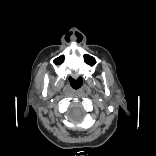 File:Bisphosphonate-related osteonecrosis of the jaw (Radiopaedia 71324-81642 non-contrast 122).jpg