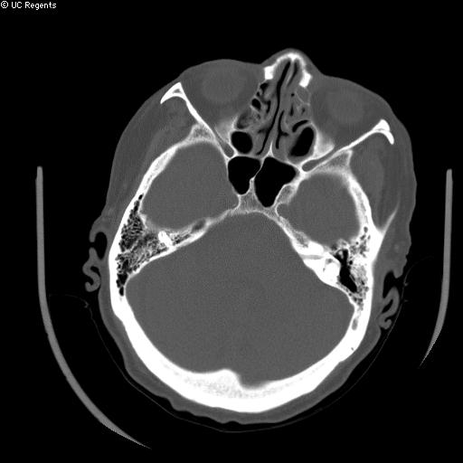 File:Bisphosphonate-related osteonecrosis of the maxilla (Radiopaedia 51367-57100 Axial bone window 15).jpg