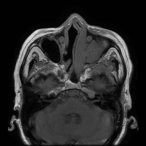 Bisphosphonate-related osteonecrosis of the maxilla (Radiopaedia 51367-57101 Axial T1 33).jpg