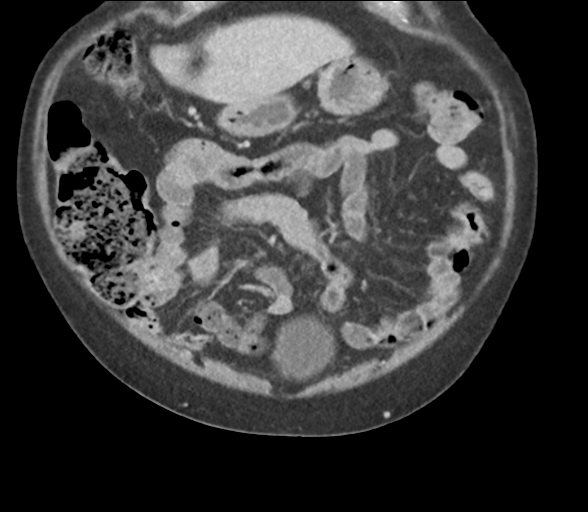 File:Bladder papillary urothelial carcinoma (Radiopaedia 48119-52951 C 18).png