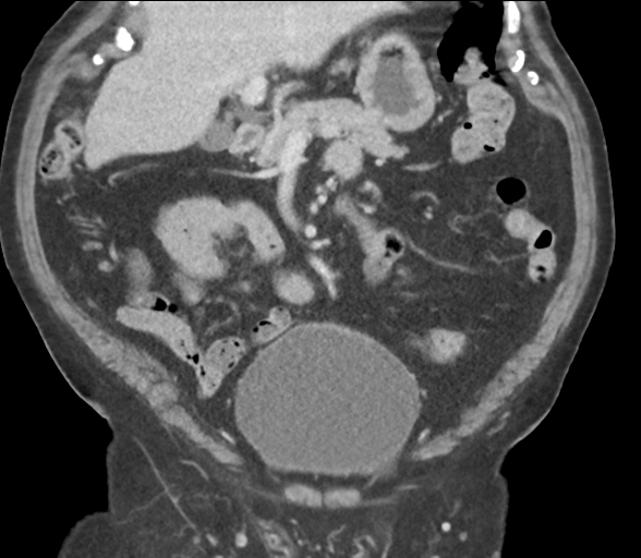 Bladder papillary urothelial carcinoma (Radiopaedia 48119-52951 C 29).png