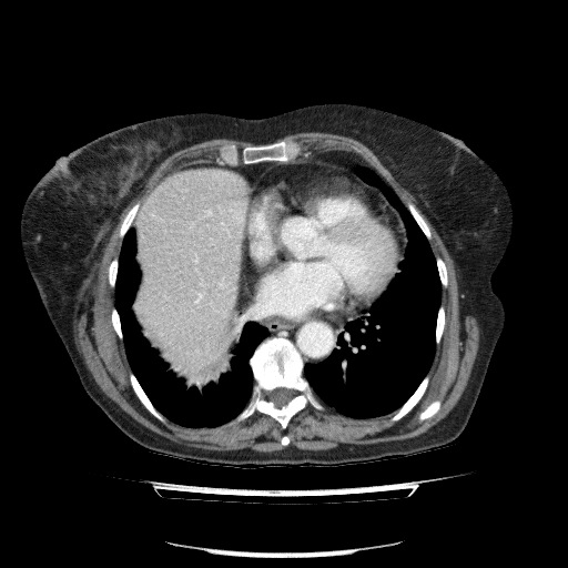 File:Bladder tumor detected on trauma CT (Radiopaedia 51809-57609 B 9).jpg