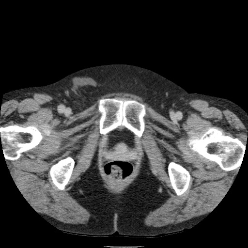 Bladder tumor detected on trauma CT (Radiopaedia 51809-57609 C 142).jpg