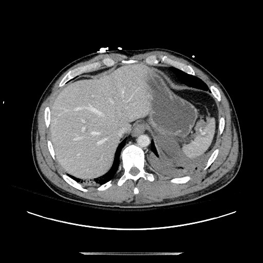 Blunt abdominal trauma with solid organ and musculoskelatal injury with active extravasation (Radiopaedia 68364-77895 A 21).jpg